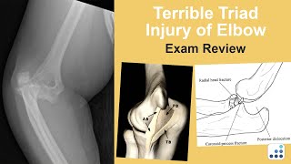 Terrible Triad Injury of Elbow Exam Review - Mark S. Cohen, MD