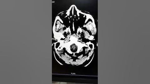 Artifact in CT scan images(6)