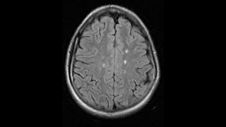 CQV E1: Multiple Sclerosis - Is Chiropractic Safe and Does It Help?