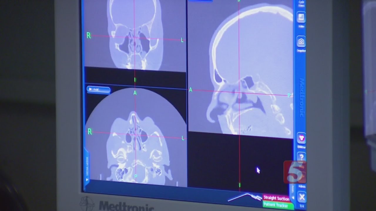 Chiari Malformation: Not Just A Headache