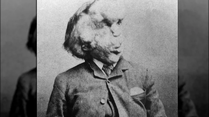 The Sad And Tragic Story Of Joseph Merrick