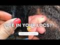 Lice in Locs?! Here’s How to Get Rid of It FAST 🚨