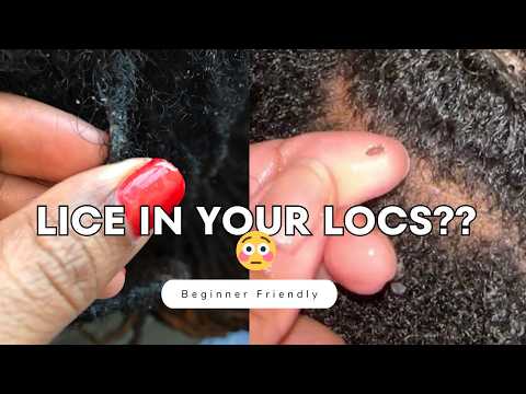 Lice in Locs?! Here’s How to Get Rid of It FAST 🚨