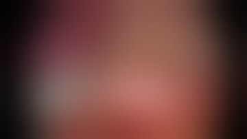 Non-edited right-upper lobectomy (RUL) uniportal VATS