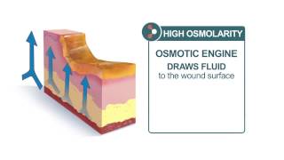 Why Should You Choose MEDIHONEY® For Your Wound Care Needs?