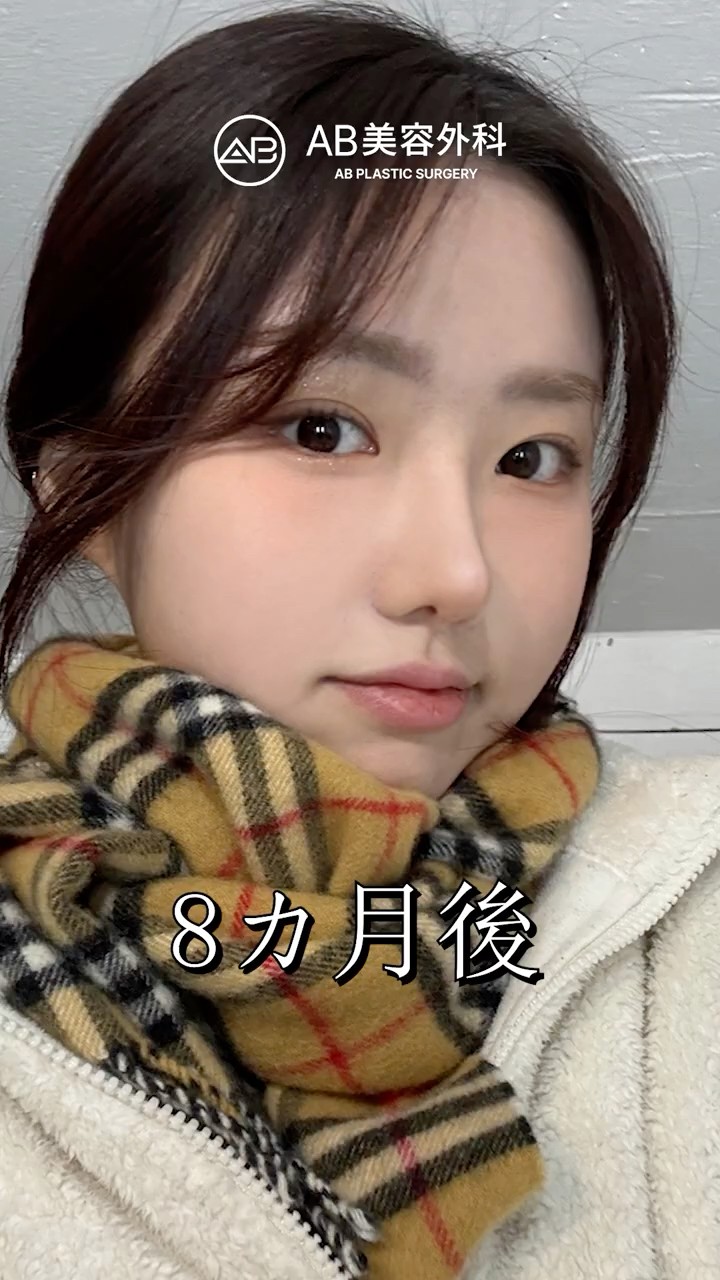 韓国で目鼻整形したら別人級の美人に！ #shorts