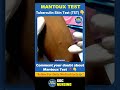 🩺💉 Mantoux Test (TST) Explained 🦠 | Tuberculin Skin Test Procedure &amp; Interpretation 🔬#nursingstudent