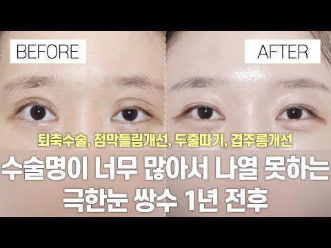 눈 성형 전후 | 수술명이 너무 많아서 나열 불가능 극한눈 | 퇴축수술, 점막들림개선, 두줄따기, 겹주름개선 1년