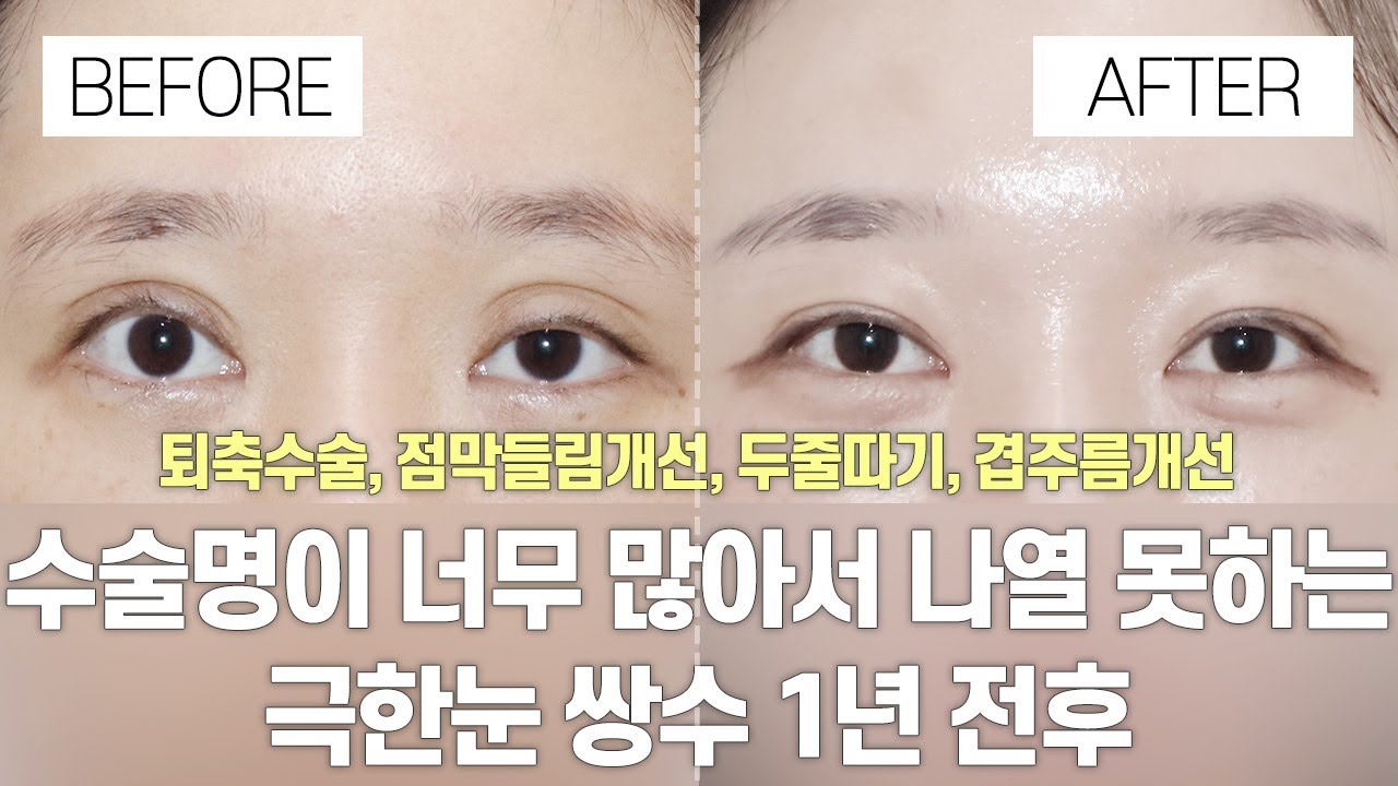 [Ганнам Сэён гоо сайхны мэс заслын эмнэлэг] Нүдний гоо сайхны мэс заслын өмнө ба хойно | Мэс заслын нэрс хэт олон тул жагсаах боломжгүй, маш хүнд нүд | Зовхины хорчийлтыг засах мэс засал, салст