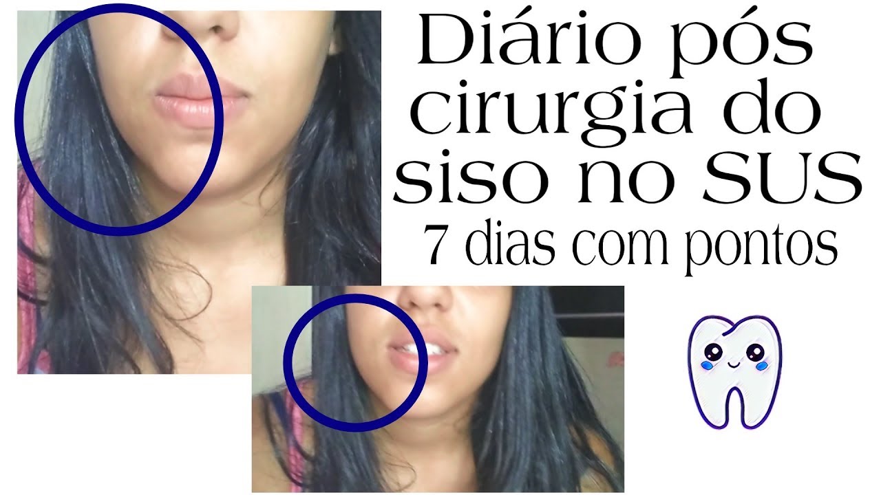 PÓS CIRÚRGICO DO SISO PELO SUS - atestado, dor, alimentação e mais ...