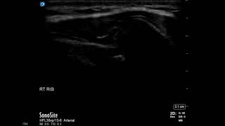 Rib Ultrasound: Subluxation at the Costochondral Junction (Long Axis)