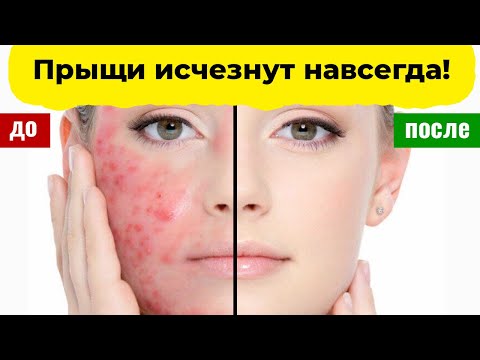 Маска от прыщей из помидоров. Как избавиться от прыщей в домашних условиях.