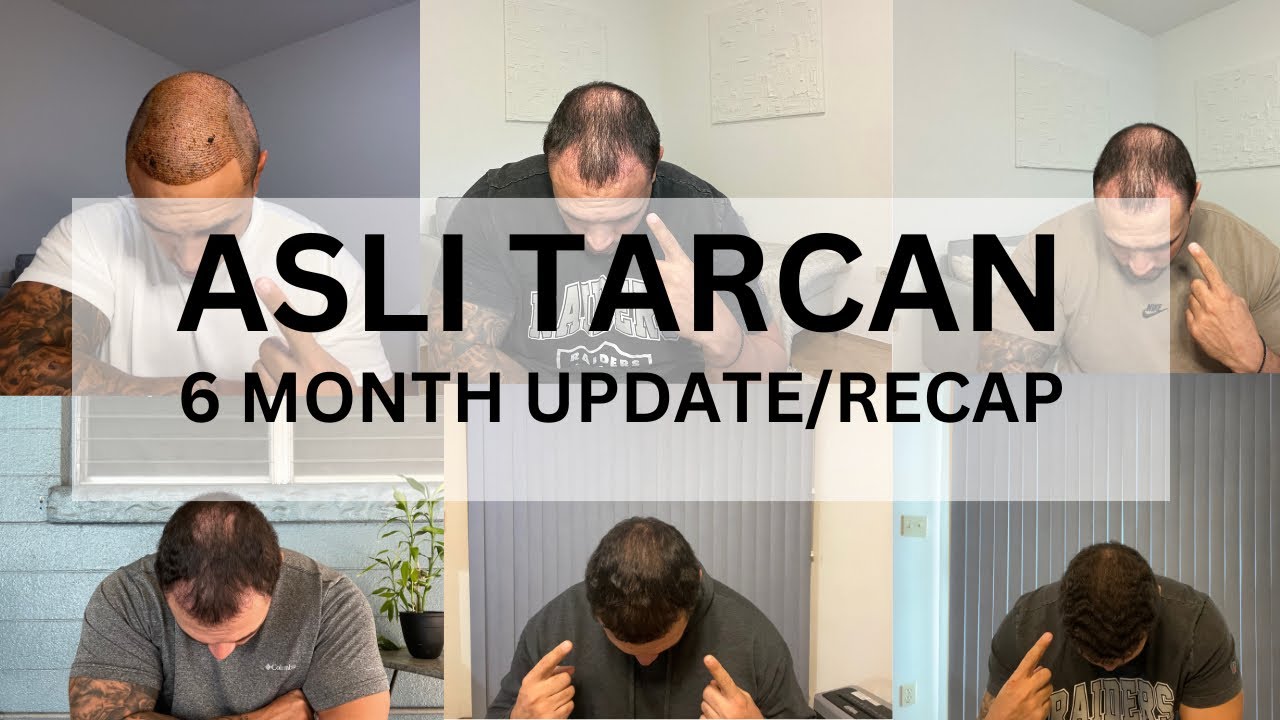 ASLI TARCAN - FUE HAIR TRANSPLANT- 6 MONTH UPDATE/ RECAP