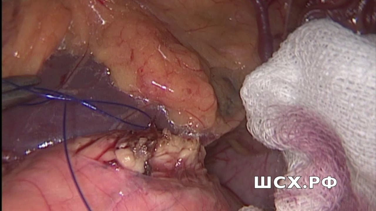 Энуклеация инсулиномы поджелудочной железы