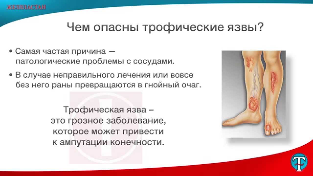 Трофическая язва: комплексная терапия с применением препарата ...