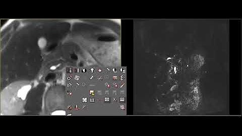 Biliary Disease - AIDS  Patient with Cholangiopathy