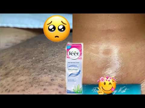 I USED VEET HAIR REMOVAL CREAM TO GET RID OF INGROWN HAIR