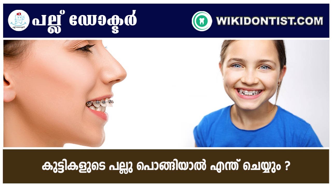 കുട്ടികളുടെ പല്ലു പൊങ്ങിയാൽ എന്ത് ചെയ്യും ?