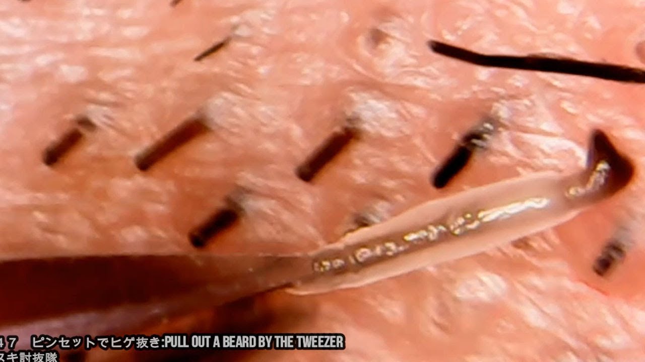 Ingrown Hair World S Worst Ingrown Hair Youtube