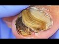 Chubby Toenails, Remove Fungus Step By Step!【Xue Yidao】