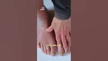 أعراض ليلية لارتفاع ضغط الدم 