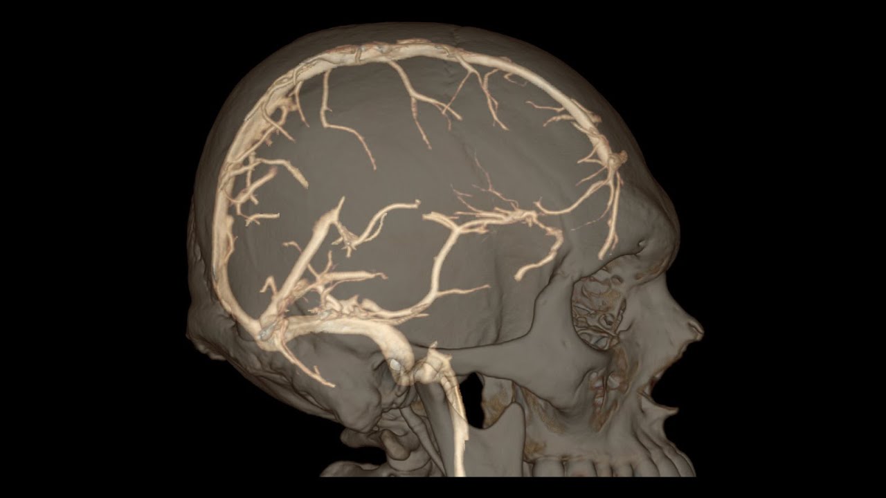 CT Brain Venogram YouTube CT Brain Venogram YouTube