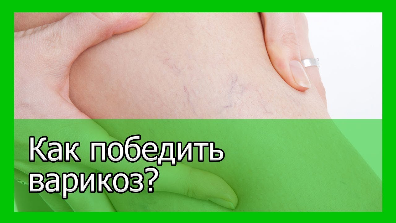 Как выглядит варикоз картинки