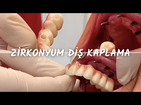 İmplant Üstü Zirkonyum Diş Kaplama