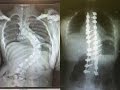 Spine Surgeon's Greatest Challenge of His Career | Dr. Ted Belanger Performs Life Changing Surgeries