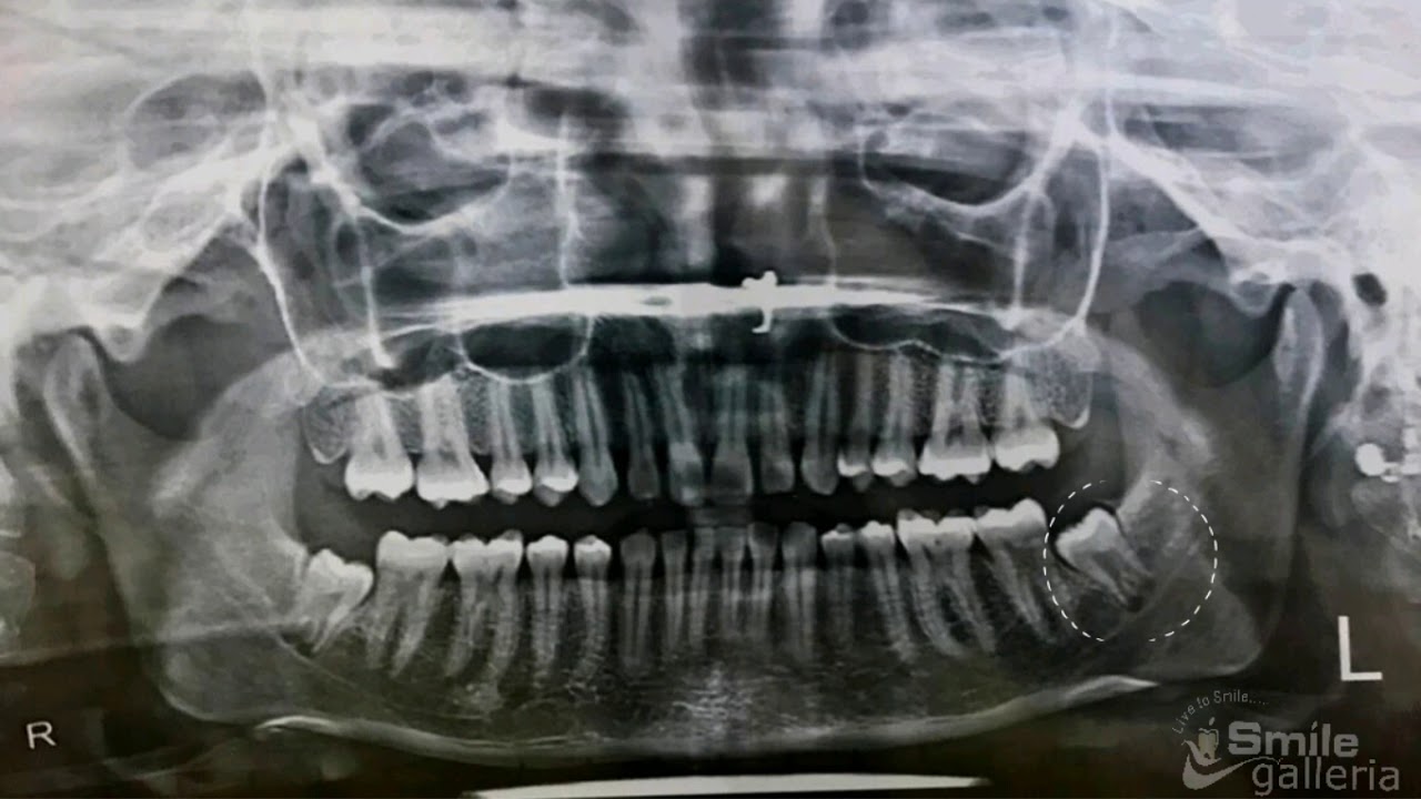 ⁣Impacted Wisdom Tooth Removal | Immature roots | Oral Surgery | Anand | Gujarat