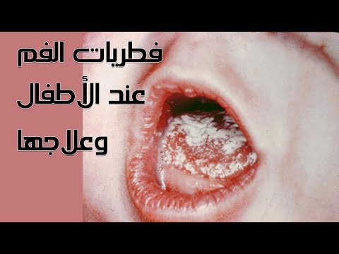 فيديو: كيفية علاج الفطريات عند الأطفال