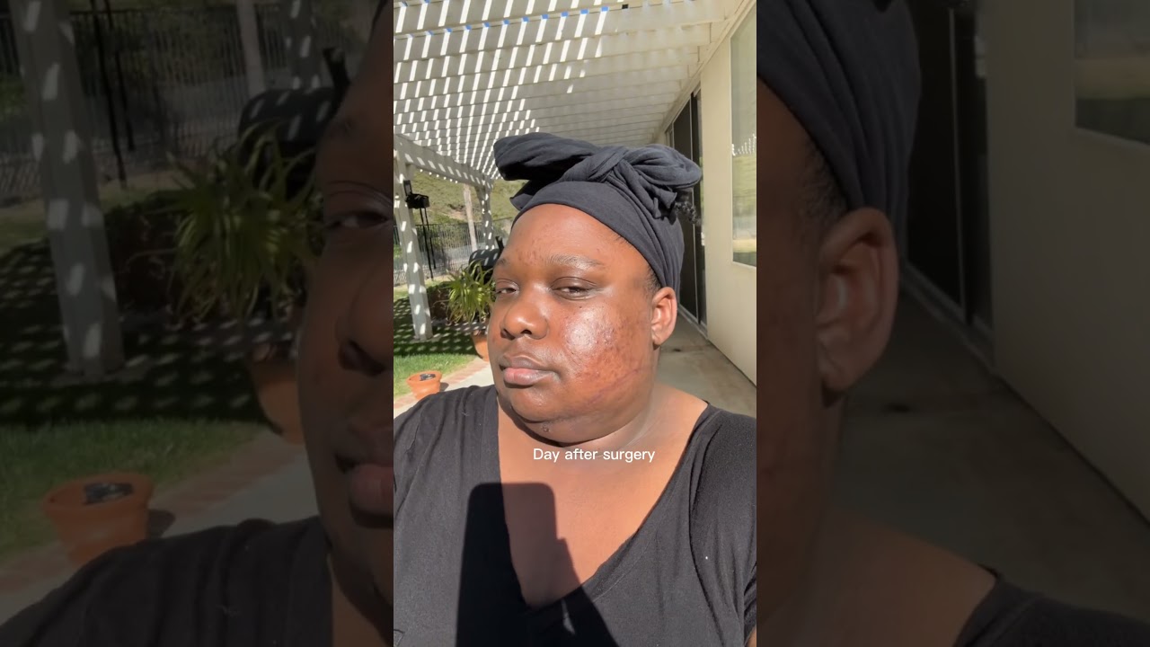 Chin Lipo & Skin Tightening was the best decision ever for me❤️