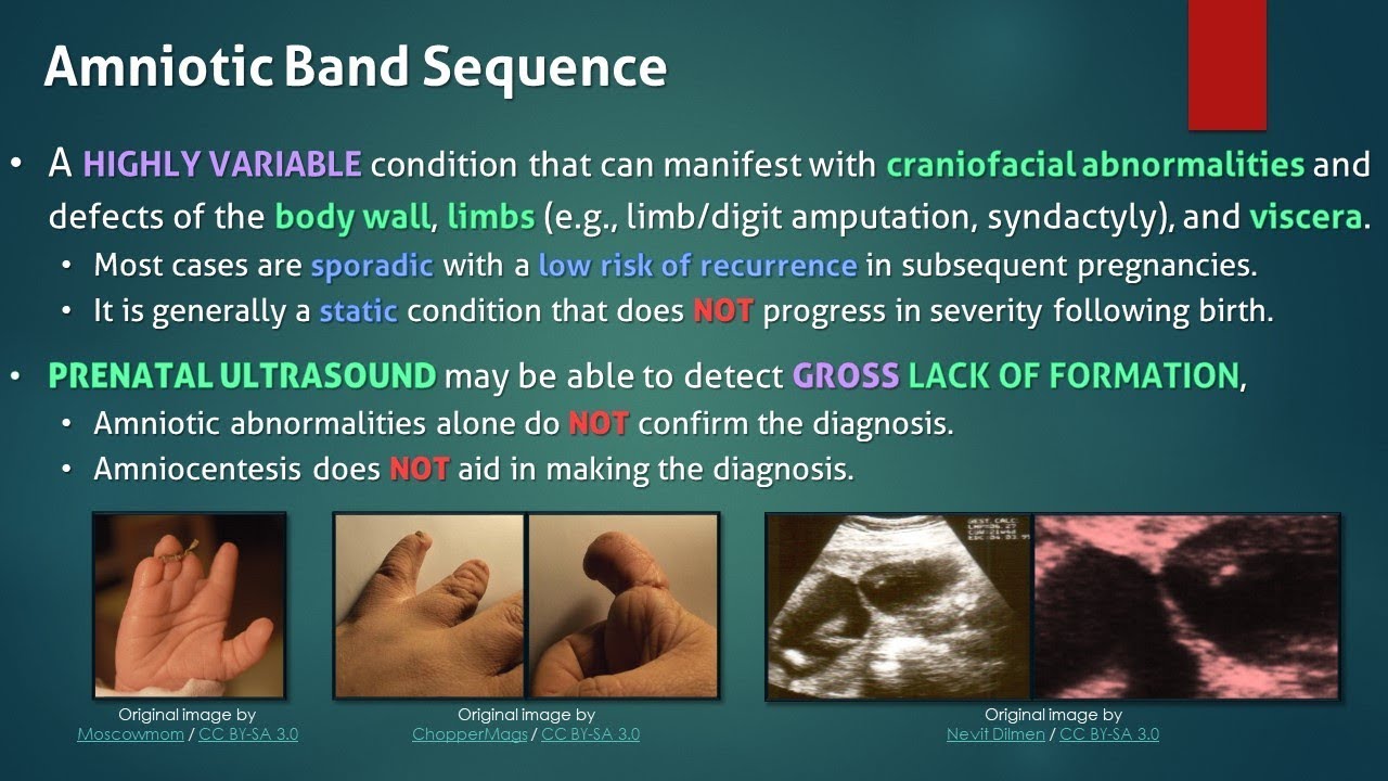 Amniotic Band Sequence YouTube