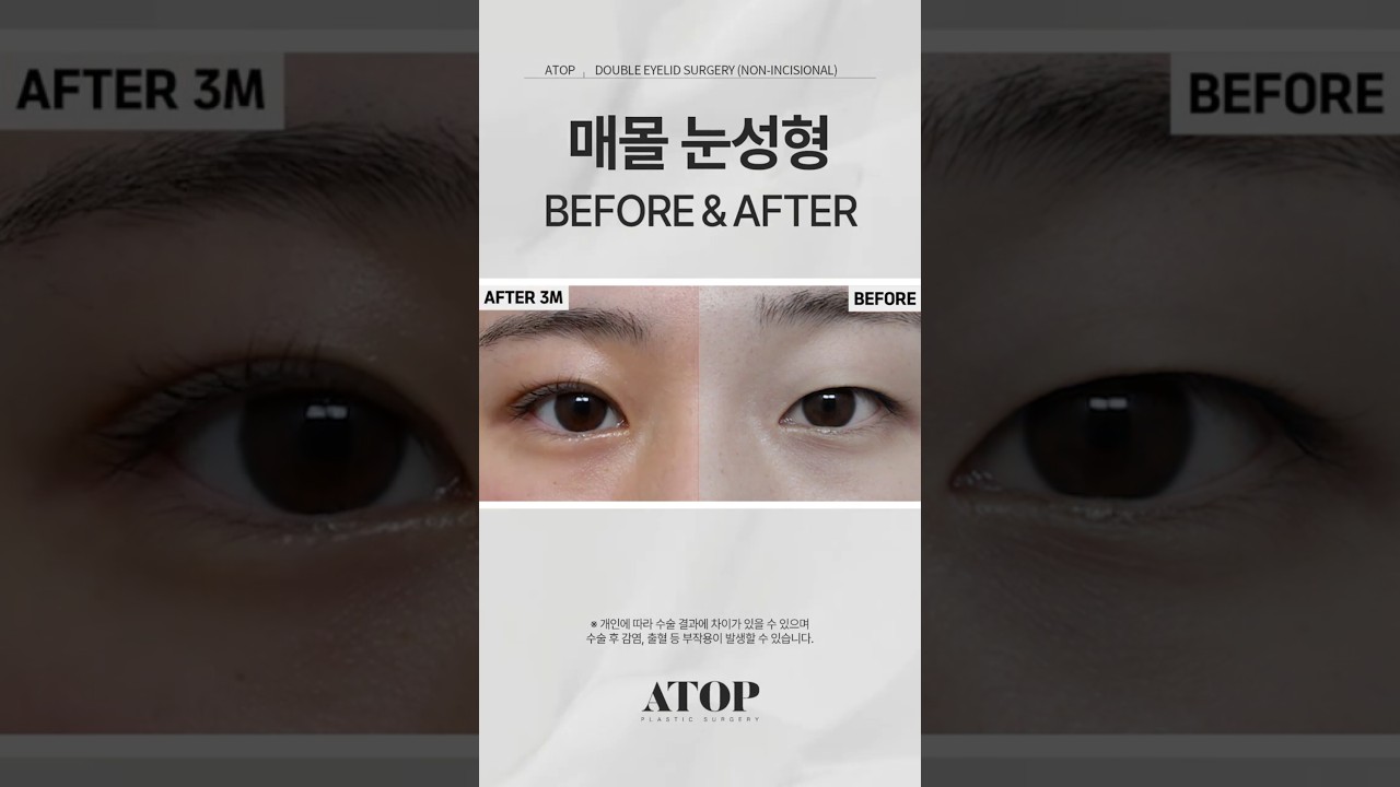 [艾塔整形外科] 女性 埋線雙眼皮_心得5