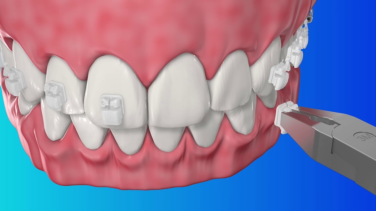 Clarity ultra Brackets de autoligado 3M Uniteck YouTube