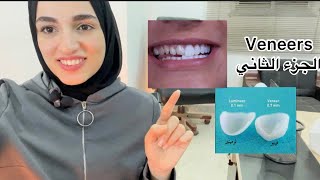 (الجزء الثاني)veneers ابتسامه هوليوود ?