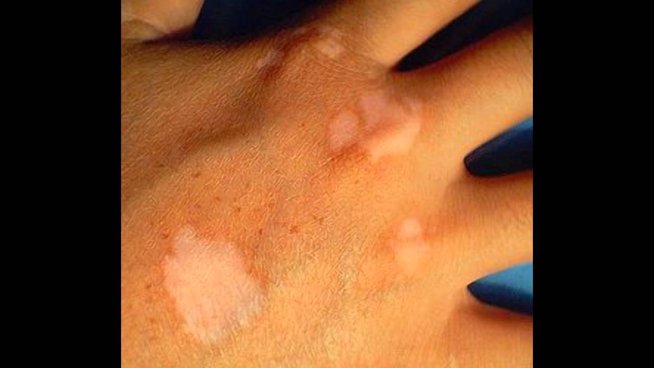 Vitiligo 