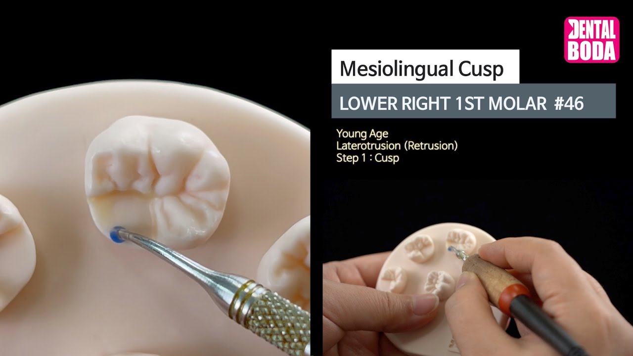 Lower Right 1st Molar mesiolingual cusp 1 cusp (youngaged) WaxUp 46
