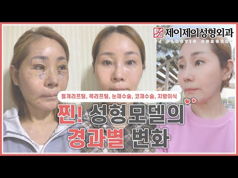 절개리프팅, 목리프팅, 눈재수술, 코재수술, <strong>지방이식</strong> 전후영상 - 제이제이성형외과 #shorts