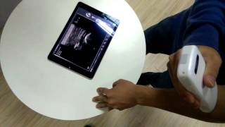 Sonostar 10.0MHz wireless linear probe video 05