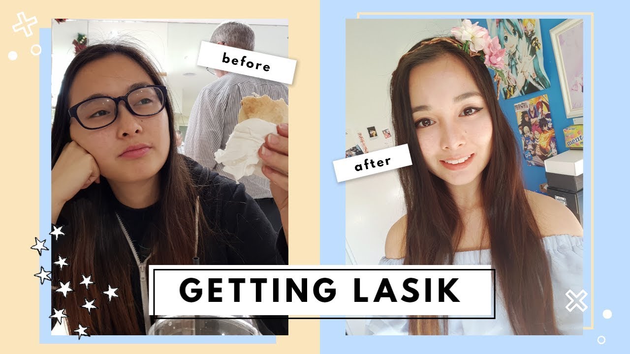 My Entire LASIK Eye Surgery Experience ACTUAL SURGERY FOOTAGE YouTube