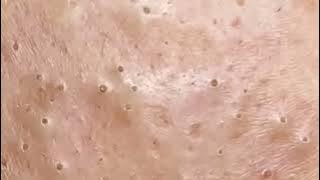 The World's Best Acne Treatment for Clear Skin #pimplepopper #Blackheadremoval #satisfying #0509