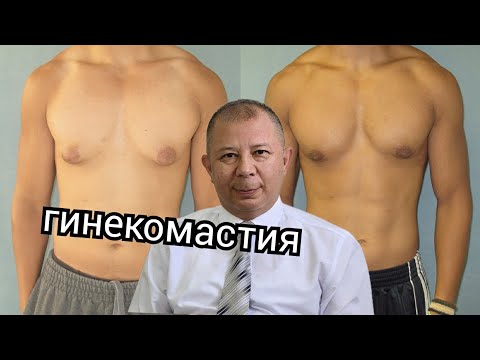 Что такое гинекомастия у мужчин. Причины, симптомы, последствия, методы лечения//Dr.JALILOV