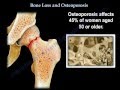 Osteoporosis - Everything You Need To Know - Dr. Nabil Ebraheim