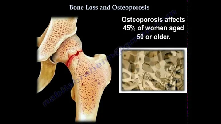 Osteoporosis - Everything You Need To Know - Dr. Nabil Ebraheim - DayDayNews