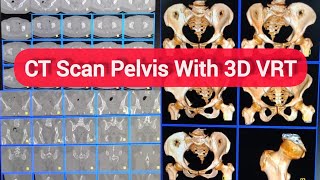 Ct Scan Pelvis With Both Hip Joint Ct Scan Hip Joint