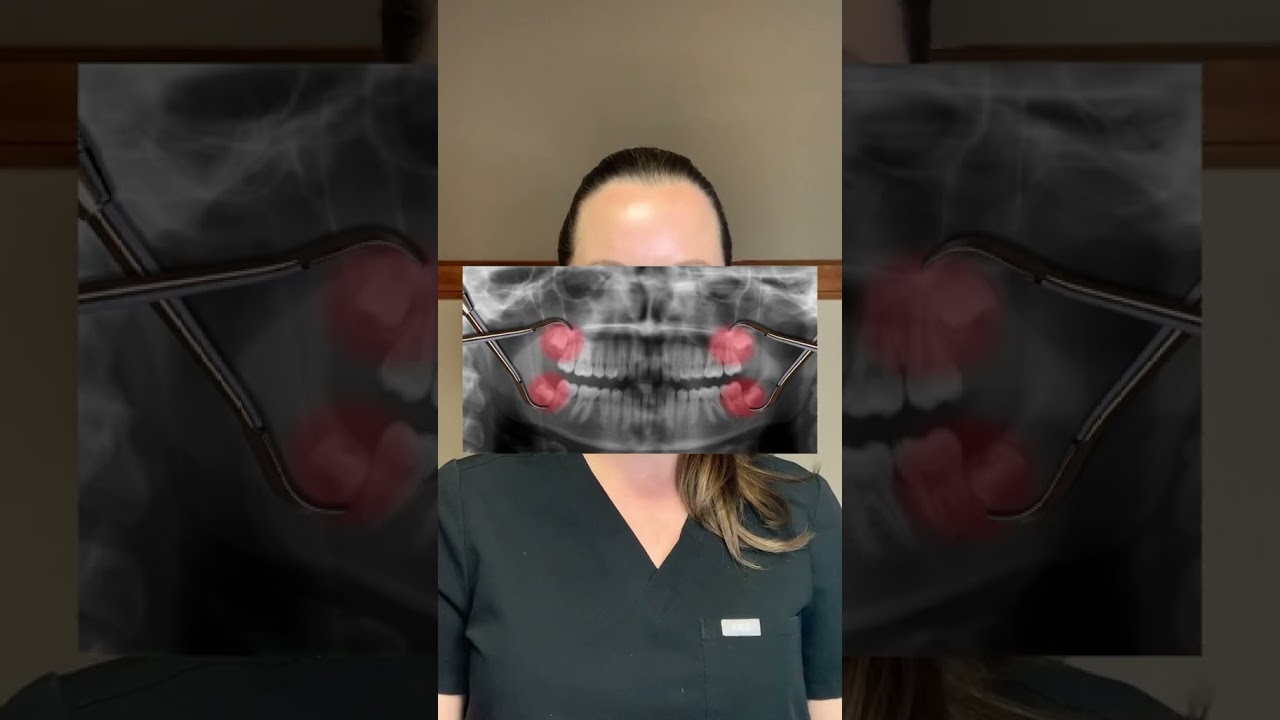 Should you get your wisdom teeth removed? #drwindhorst #choiceorthodontics #wisdomteeth