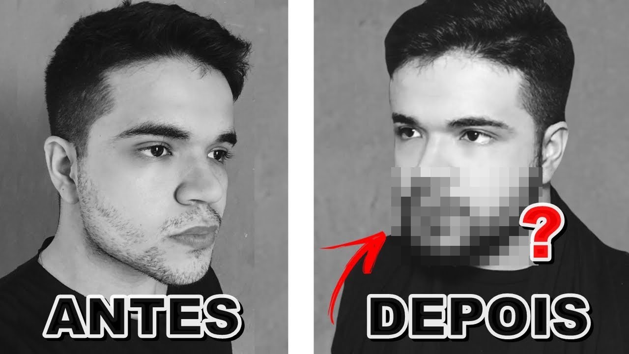 1 MÊS COM MINOXIDIL - ANTES E DEPOIS - YouTube