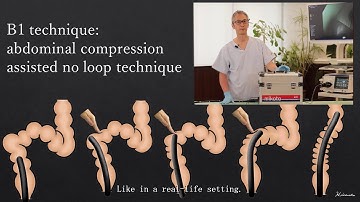 Colonoscopy Insertion Technique with mikoto Model: How to use abdominal compression?