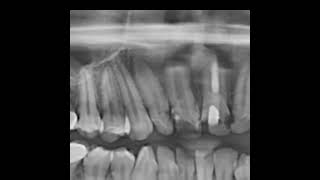 Apical barrier with Bioceramic putty#rootcanal #endo #bioceramics #obturation